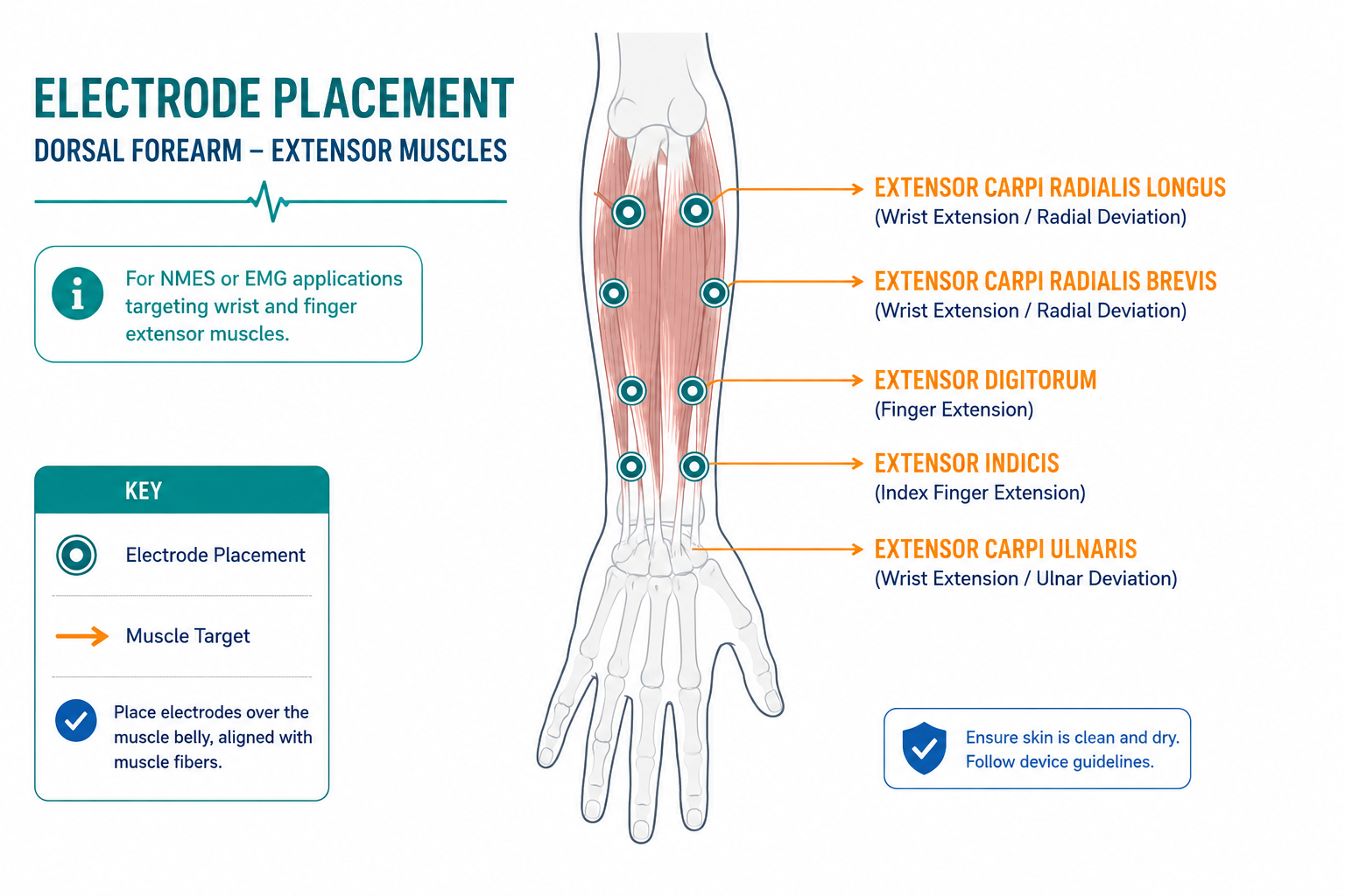 Medical diagram showing illustrative electrode placement points over the wrist and finger extensor muscles of the dorsal forearm.
